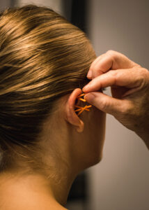 Øreakupunkturbehandling med orange nåle som del af behandling mod stress og migræne.