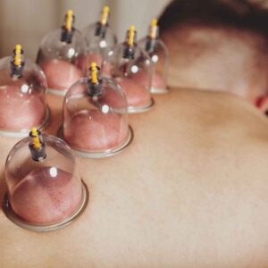 Cupping-behandling på ryggen med flere sugekopper placeret på huden – lindring af smerter i muskler og led.