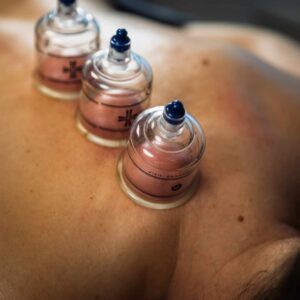 Cuppingbehandling med tre sugekopper under fysiurgisk massage på ryggen.