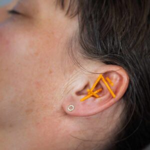 De 5 NADA punkter placeret i øret med nåle som led i akupunkturbehandling, der støtter mod stress, angst og tankemylder.