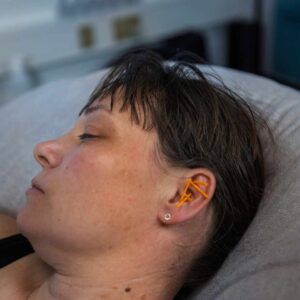 NADA behandling af tankemylder hos Susanne Vestergaard med akupunkturnåle i øret, der fremmer afslapning og mental ro.