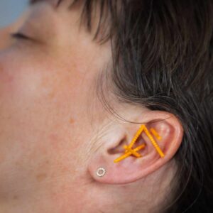 NADA øreakupunktur med nåle som effektiv alternativ angst behandling til at reducere uro, stress og skabe ro i kroppen.