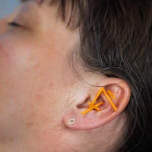 NADA akupunktur anvendt i øret som behandling mod træthed og kvalme for at skabe ro i nervesystemet og bedre velvære.