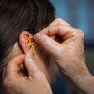 En terapeut sætter nåle i øret som del af NADA behandling der ofte bruges som naturlig metode til hvad hjælper mod kvalme.